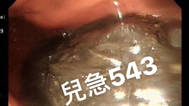 男童吃栗子險死　致命原因竟是...