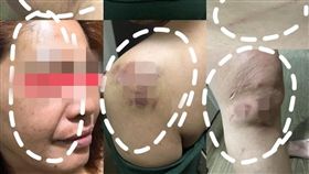 菸蒂,家暴,肋骨,台南／爆料公社