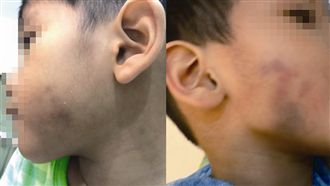 幼兒園用無照師？　男童臉頰遭捏瘀青