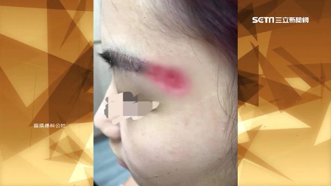 正妹當霧眉模特慘毀容　眉尾嚴重腐蝕