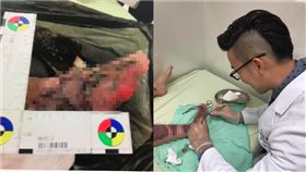 女大生摔車腳受傷未換藥，導致傷口爬滿蛆。（圖／沈彥廷醫師提供）