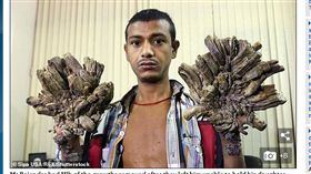 他正逐漸變成樹人！10歲起得怪病　全身長樹皮雙手成樹幹（圖／翻攝自每日郵報）