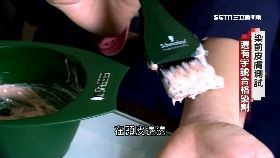 (透視)染髮劑炎腫(完成)