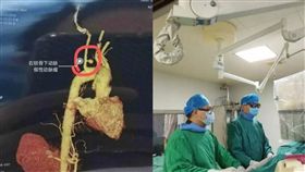 魚刺,休克,吐血,大陸,湖南,動脈瘤,換血,　圖／翻攝自微博