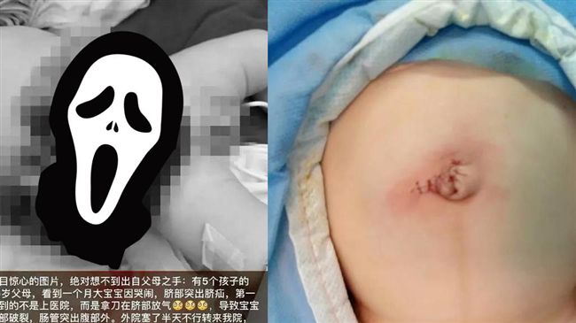 嬰肚臍鼓起…父母劃開「放氣」腸流出