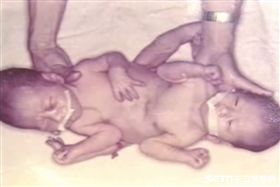 連體嬰雙胞胎（忠仁、忠義