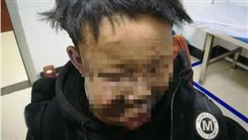 鞭炮裝死湊近看瞬間「沖了出來」　13歲少年臉部燒焦重傷（圖／翻攝自瀟湘晨報）