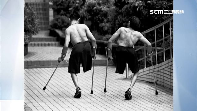 連體嬰哥哥猝逝　弟：代替他活下去