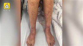 大陸,上海,怪病,乾燥症候群,紫斑（圖／翻攝梨視頻）