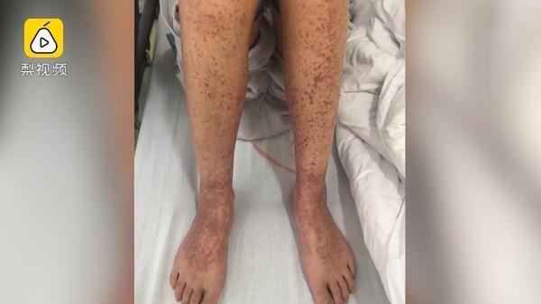女怪病纏身10年！腿長紫斑、牙掉光