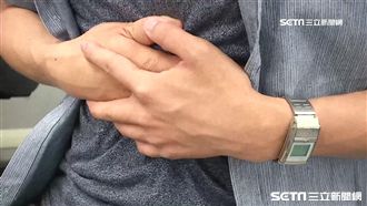 5種飲食行為恐害腸穿孔！醫：嚴重恐致命