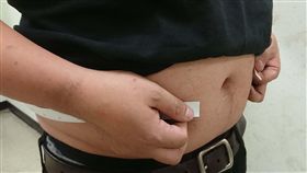 長庚研究：內臟脂肪愈多得慢性腎病風險增林口長庚紀念醫院研究發現，內臟脂肪指數（VAI）愈高的人，血壓、血脂、空腹血糖愈高，腎功能也愈差，罹患慢性腎臟病風險高出1.5倍。圖為肥胖示意。（長庚醫院提供）中央社記者陳偉婷傳真　107年12月30日