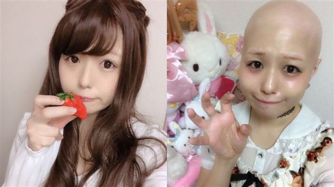 怪病纏身！15歲女星1年毛髮全掉光
