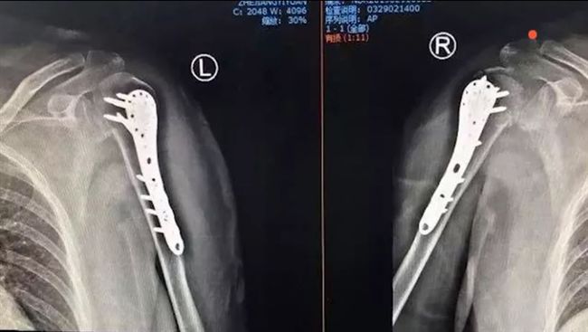僅「愛的抱抱」　妻竟雙肩粉碎性骨折