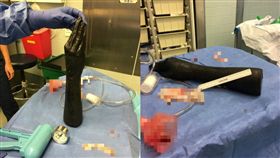 扯爆！整隻手插進肛門卡住　醫生拔出都傻眼(圖/社群網站《VK》)