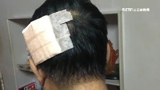 午睡被偷襲！男遭獼猴「報復」咬破頭