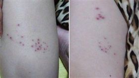 帶狀皰疹,皮蛇,飛蛇,成大醫院,皮膚科,畫符念咒,爆廢公社