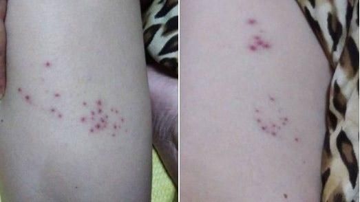 發作痛不欲生　這些人當心皮蛇纏身…