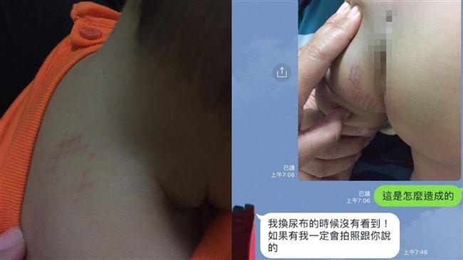 保母拿吹風機施虐？男嬰下體驚見烙痕