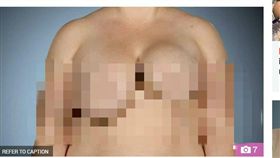 美國,隆乳,大小奶,愛莉卡,整形（圖／翻攝自太陽報）
