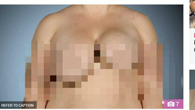 為討男友開心！她隆乳失敗慘變大小奶