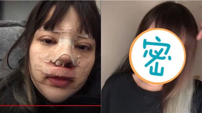插畫家自爆整型！紗布拆開臉全變了…
