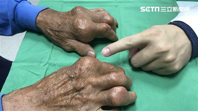 狂吃海鮮、火鍋　男關節變形如千針刺