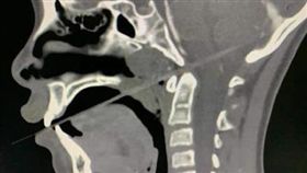 大陸,竹籤,彈跳床,熱狗,手術
https://s.weibo.com/weibo/%25E7%2586%25B1%25E7%258B%2597?topnav=1&wvr=6&b=1