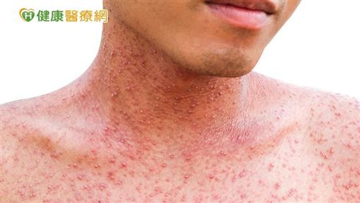 感染麻疹常見症狀有發燒、出疹、鼻炎、結膜炎、咳嗽,以及發燒3-4天後口腔內出現斑點(柯式斑點),較嚴重者會併發中耳炎、肺炎或腦炎。
