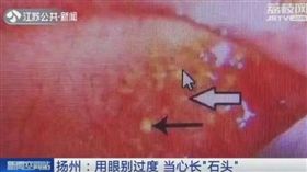 大陸,隱形眼鏡,眼結石,眼妝,眼睛（圖／翻攝自新浪新聞）