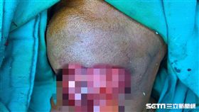 南投一名50歲男子，去年起覺得下巴長了顆痘痘，最後腫到比雙下巴還脹，就醫檢查竟是粉瘤作怪。（圖／南投醫院提供）