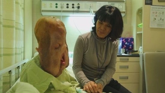 罕病妹五官融化　手術完撐不過走了！
