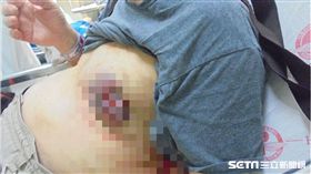 58歲大叔得乳癌／台中中國附醫提供