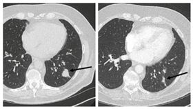英國病患自行服用大麻油後，腫瘤變細小。（圖／翻攝自SAGE Journal）