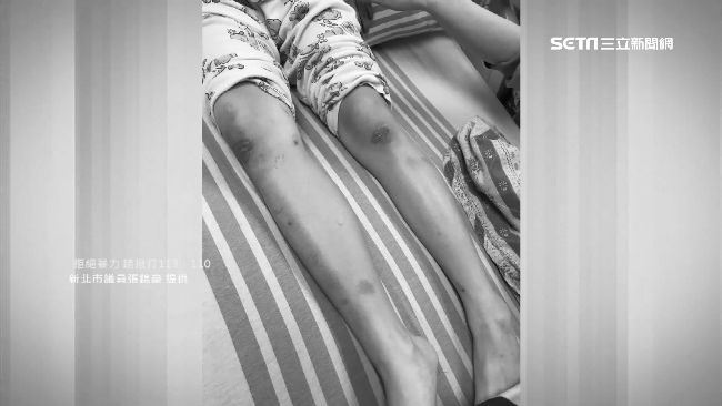 昏迷女童腳遭疑有傷　母喊冤：是胎記