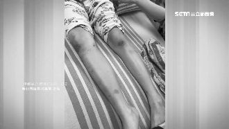 昏迷女童腳遭疑有傷　母喊冤：是胎記