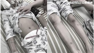 11歲女童全身傷昏迷　去年底曾通報