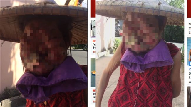 6旬罕病婦全臉變形…每晚被迫與狗睡