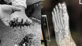 外勞顧聽音樂，高齡98歲老爺爺腳指頭磨破流血。（圖／翻攝自爆怨公社）