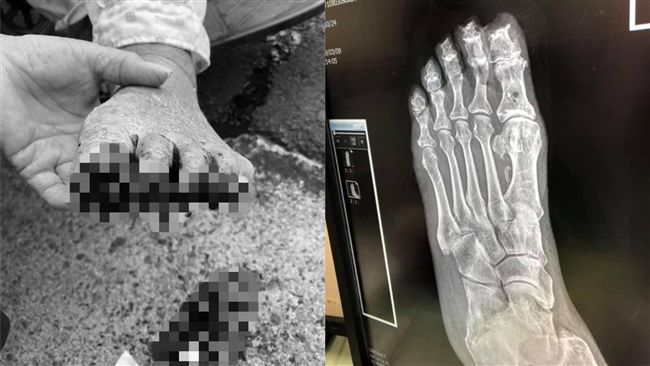 外勞顧聽音樂！98歲爺腳趾磨爛噴血