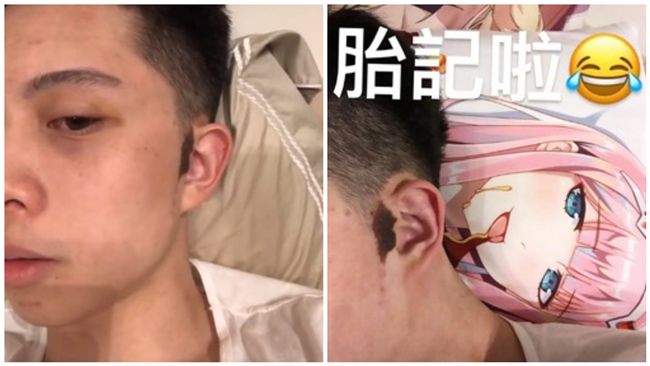 很多人誤會孫安佐的胎記。（圖/翻攝孫安佐IG）