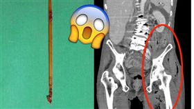 圖／高雄長庚紀念醫院提供,牙籤吞肚