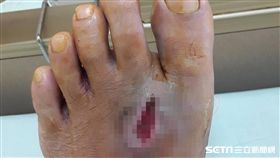 患者趙先生日前不幸遭到鐵釘插入左腳掌。（圖／記者楊晴雯攝）