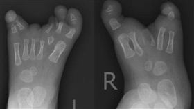 大陸,廣東,深圳,女嬰,龍蝦,畸形,罕病