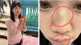 玻璃擦太乾淨…高嘉瑜撞到鼻青臉腫　圖／翻攝自高嘉瑜臉書