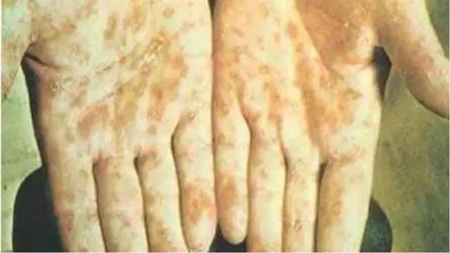 沒性生活也中鏢？8旬老翁衰染梅毒