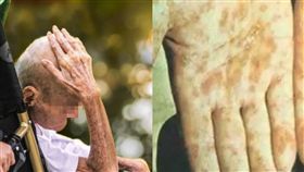 沒性生活也中鏢？8旬老翁衰染梅毒　醫師曝恐怖真相　圖／翻攝網易新聞，ｐｉｘａｂａｙ