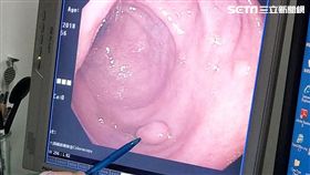 癌症,大腸癌,息肉,大腸息肉,癌變,衛福部彰化醫院,楊智超,大腸鏡

圖／翻攝自衛福部彰化醫院臉書