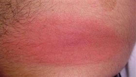 感染萊姆病引起的遊走性紅斑。（圖／翻攝自美國疾管署官網）