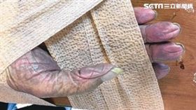 圖／台南奇美醫院提供,手中風